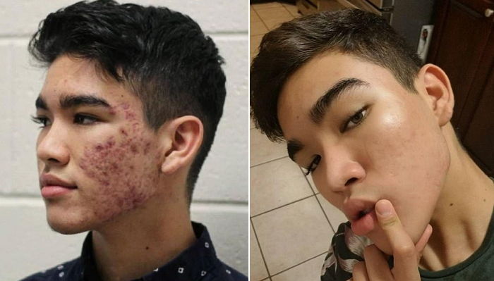 ‘저렴이’ 화장품만 써서 8개월 만에 여드름 싹 없애버린 소년