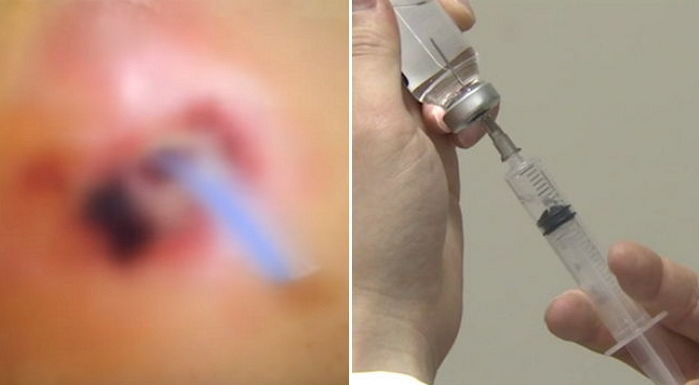 “병원서 감기 주사 맞았는데 피부가 썩고 있습니다”