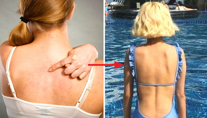 다가오는 여름 당당하게 수영복 입기 위해 ‘등드름’ 없애는 꿀팁 5