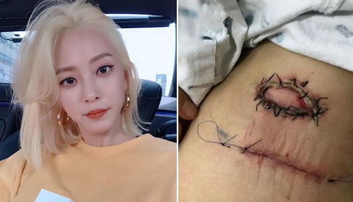 유명 의학박사 “한예슬 ‘지방종’ 의료사고 맞다…흉터 남을 것”