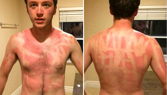 땡볕에 ‘선스틱’ 대충 발랐다가 ‘몸테러’ 당한 남성에게 쏟아진 문의글