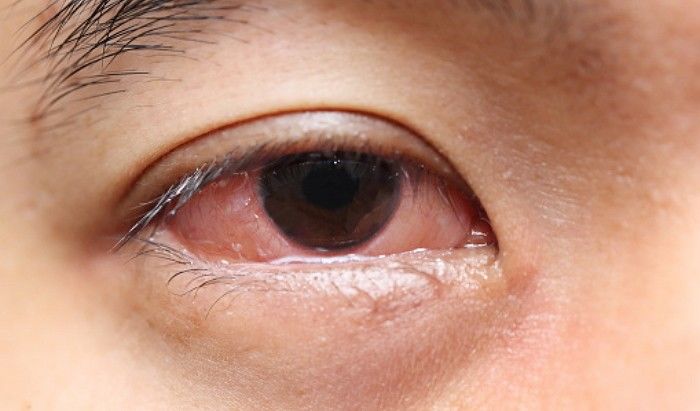 ‘종강’ 앞두고 날 더워지면서 유행성 결막염 환자 급증