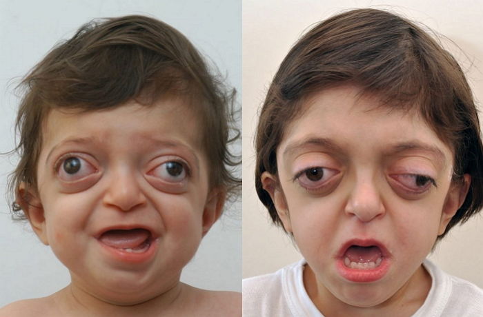 수술 후 ‘안면기형’ 완전히 고치고 생애 처음 활짝 웃은 소년