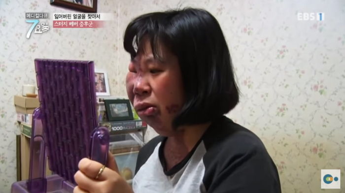 얼굴이 부풀어 오르는 희귀병 때문에 ‘17번’ 수술하고도 미소 잃지 않는 민혜 씨