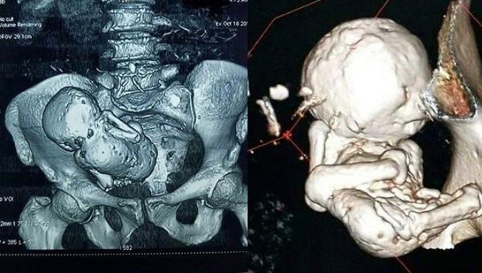 배 속에서 숨져 ‘화석’으로 변한 태아를 무려 60년간 품고 산 엄마