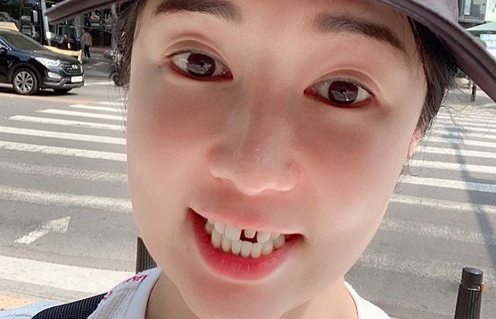 라미네이트 사라져 앞니 뻥 뚫렸는데도 “바람 잘 통해서 좋다”는 ‘긍정甲’ 사유리