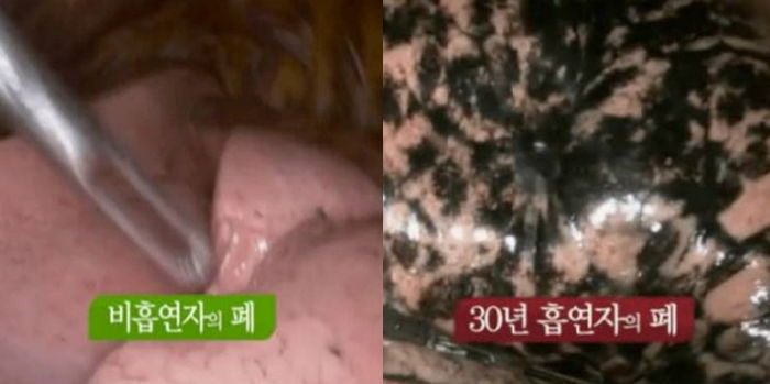 30년간 담배 피운 사람과 비흡연자의 ‘폐’를 내시경으로 들여다봤다