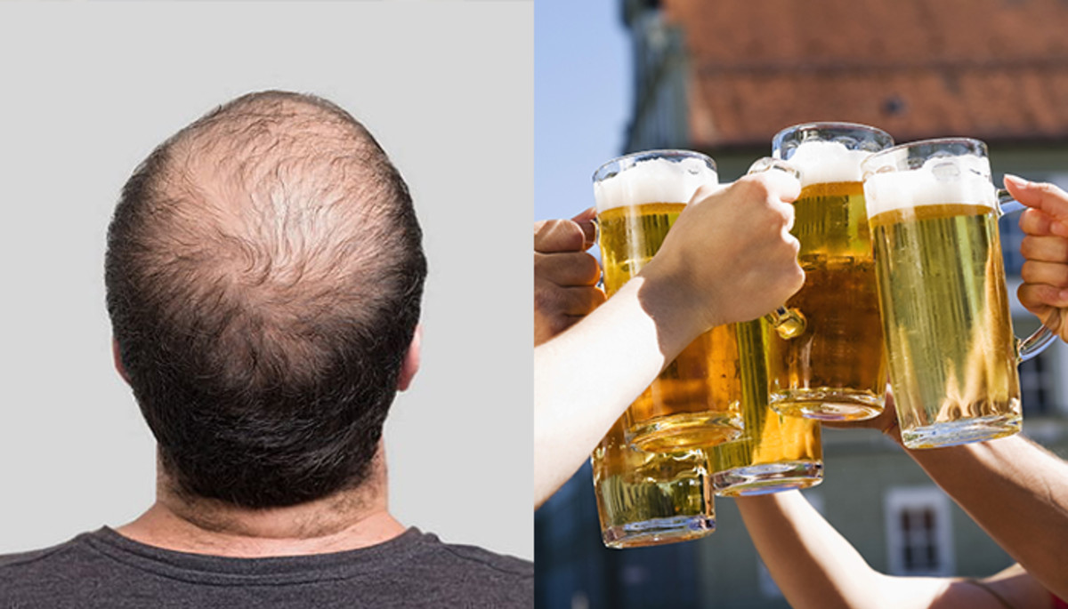 퇴근하고 벌컥벌컥 마신 ‘맥주’로 탈모 예방할 수 있다