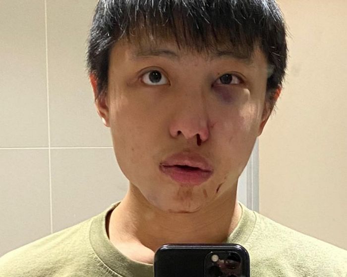 “아시아인은 꺼져”…코로나19 확산에 ‘무차별 폭행’ 당한 남성이 공개한 사진