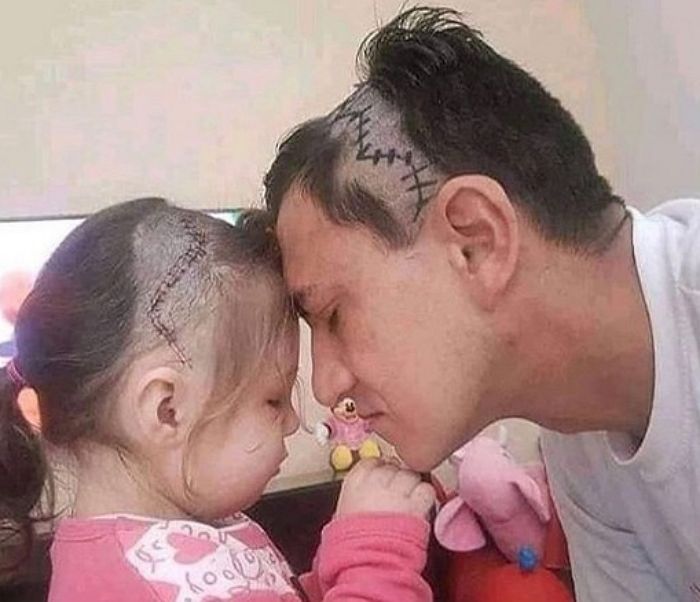 뇌수술 흉터 보기 싫다며 ‘슬퍼하는 딸’ 위로하려 아빠가 선택한 방법