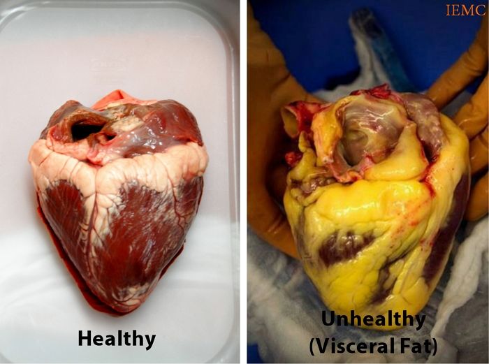 다이어트에 실패한 비만 환자의 ‘노란 심장’을 일반인과 비교해봤다