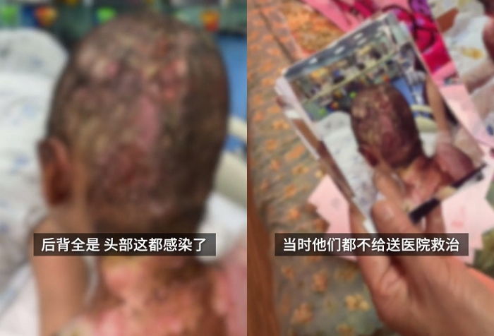 “끓는 물에 화상 입고 치아까지 뽑혀도...” 6살 딸은 새아빠에게 반항도 못 했다