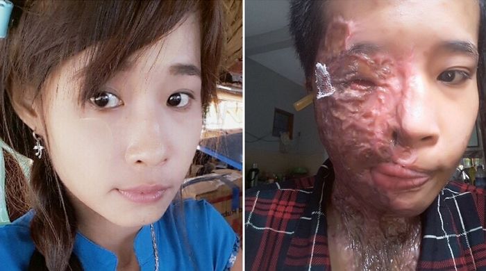 “다른 남자한테 절대 못 가”…이별통보 하자 전남친에 ‘염산테러’ 당한 여성