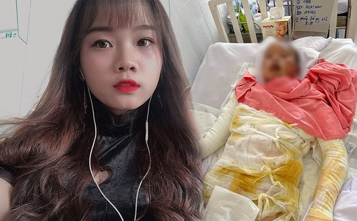 몸 70%에 화상 입고 깨어난 여성은 남친 죽은 줄도 모르고 결혼을 꿈꿨다