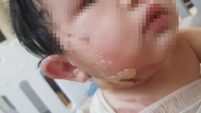 “코로나 확진 아빠 때문에 치료 거부당한 ‘2도 화상 아기’를 도와주세요”
