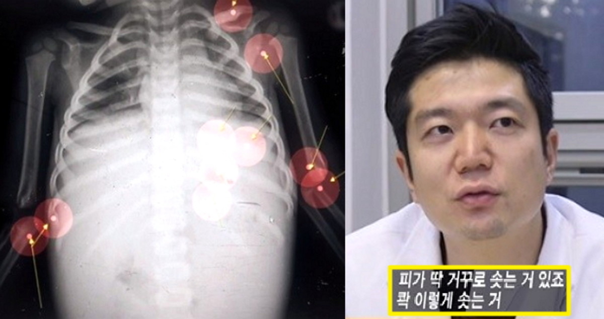“16 months break your ribs?  Child abuse to the extent that it appears in textbooks” …’Jung Ini case’ seen by a doctor