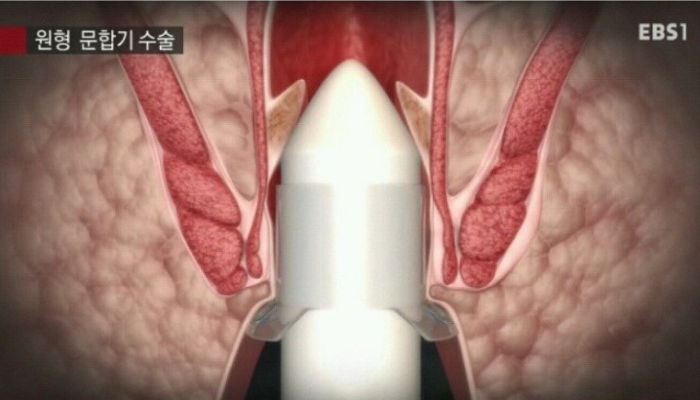 치질·치핵이 얼마나 고통스러운지 ‘간접 경험’할 수 있는 수술 영상