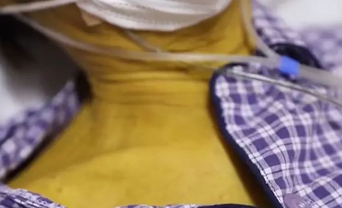 30년간 ‘흡연+음주’ 즐기다 온몸 샛노랗게 변한 남성의 충격적인 상태 (영상)