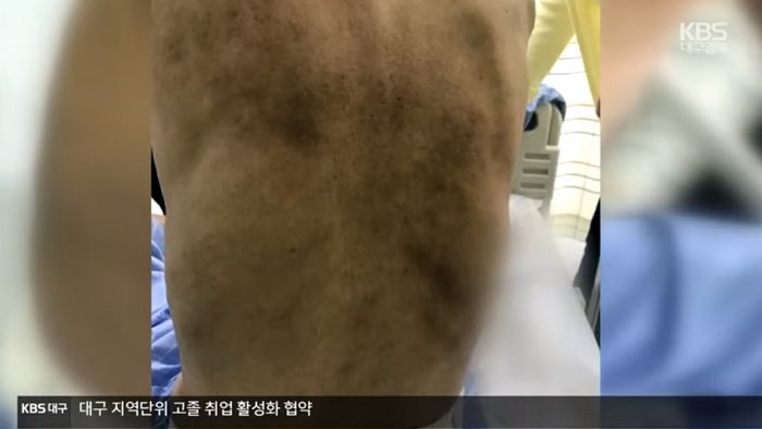 “세달 동안 안 씻겼다”…코로나로 면회 금지된 사이 환자 방치해 ‘피고름’ 생기게 만든 병원