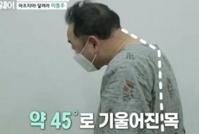 허리·목 굽어 못 펴는 난치병 걸린 이봉주를 본 전문의가 내놓은 소견