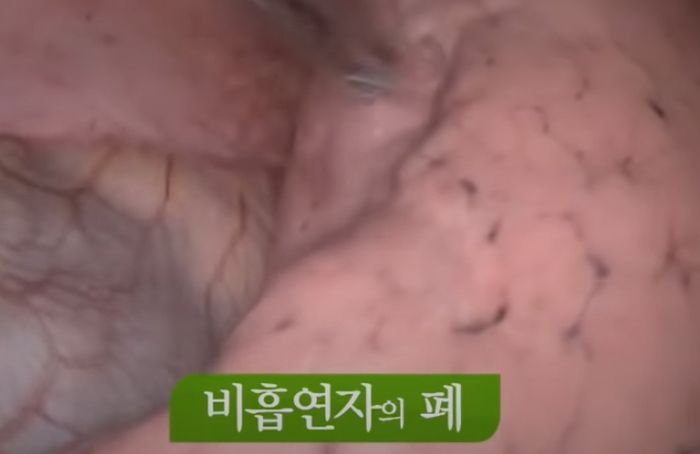 비흡연자와 담배 30년 피운 흡연자의 충격적인 폐 상태 비교 (영상)