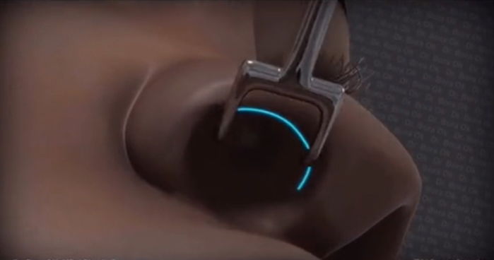 한번 보면 살 떨려서 ‘코 성형’ 절대 못 한다는 수술 과정 (영상)