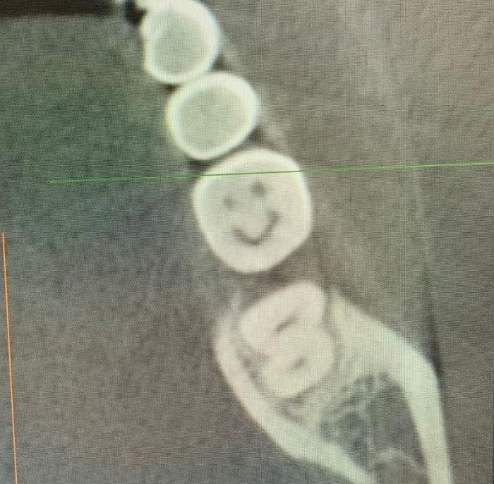 “치통이 너무 심해 엑스레이 찍었더니 사랑니가 ‘악마의 미소’를 짓고 있었습니다”