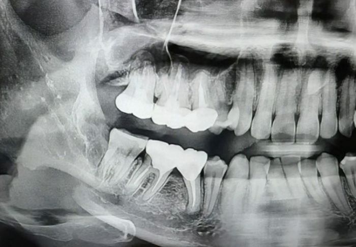 사랑니 뽑다 턱뼈 두 동강 내놓고 사과 안 한 제주도 모 치과