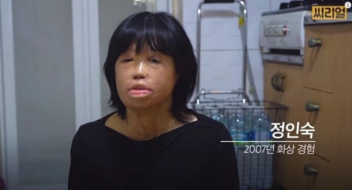 “피부병 옮지는 않겠죠?”…사고로 ‘전신화상’ 입은 여성이 중고 거래 구매자에게 받은 문자