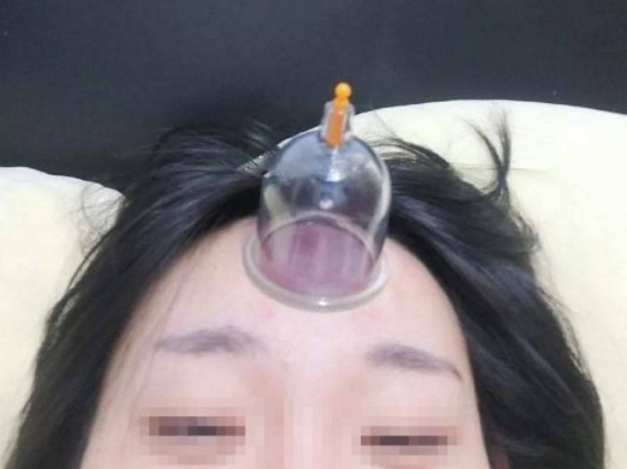 손 안 대고 피지 짜려고 이마에 ‘부항’ 떴다가 드래곤볼 ‘프리저’ 된 여성