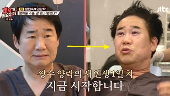 공유 무쌍인데 ‘쌍수’한 남편 최양락에 “공유 닮아졌다” 칭찬한 팽현숙 (영상)