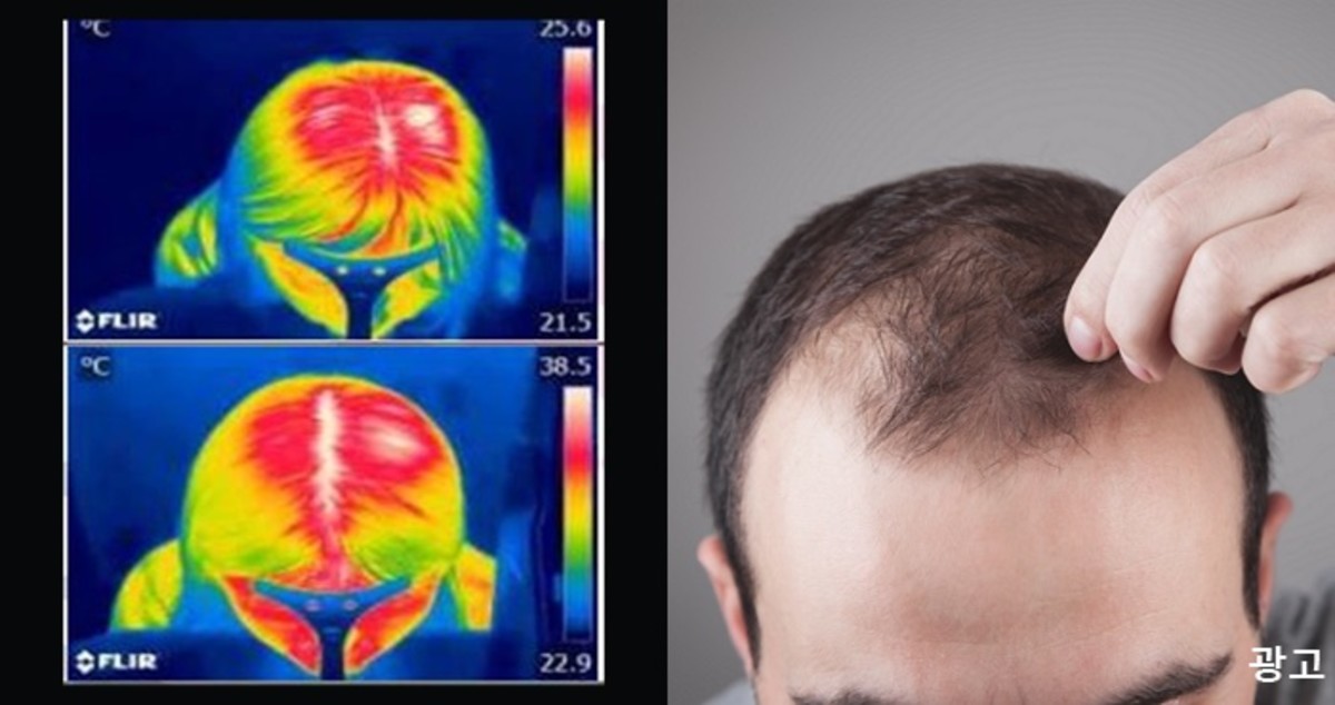 역대급 폭염+스트레스로 두피에 열나는 당신, 탈모 위험 1순위