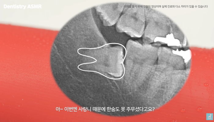 상상보다 더 끔찍하다는 ‘매복 사랑니’ 뽑는 과정 (영상)