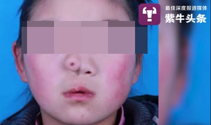 가난한데도 ‘콧구멍 짝짝이’라고 버림받은 아이 입양해 코 수술시켜준 양부모