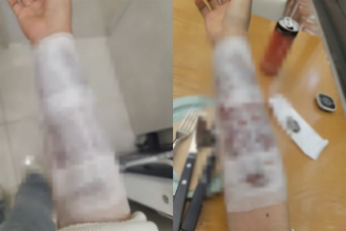 팔에 새긴 문신 후회돼 ‘제거 시술’ 받은 타투이스트가 전한 고통 수준