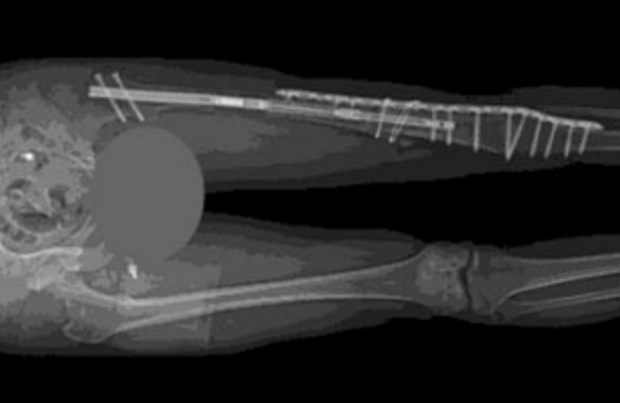 키 158cm 청년이 1억으로 ‘키 크는 수술’ 받는다 하자 전국의 ‘키작남’들이 남긴 인생 조언