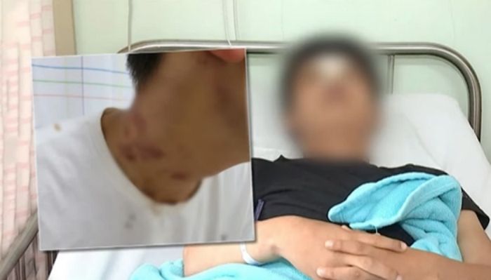 ‘1만5천원’ 안 갚았다고 후배 광대뼈·코뼈 부러질 때까지 집단 폭행한 고교생 4명 (영상)
