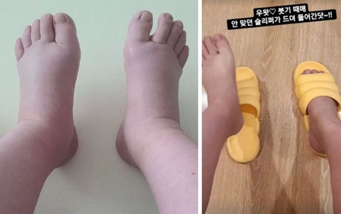 몸무게 104kg 찍더니 ‘세쌍둥이 출산’ 후 부기 빠져 안 맞던 슬리퍼 신고 인증샷 찍은 황신영