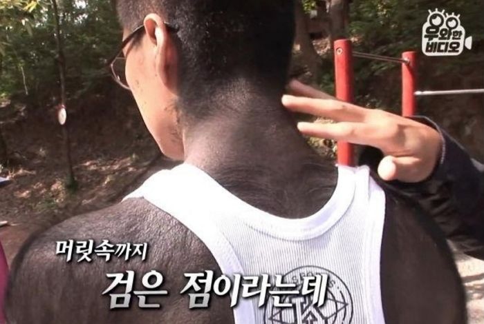 왕따 당하던 아들이 “내 몸 뒤덮은 점이 멋지다”고 생각하게 만든 아빠의 한마디 (영상)