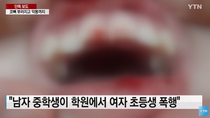촉법소년 남중생이 폭행해 ‘코뼈+앞니’ 부러진 초등학교 여학생