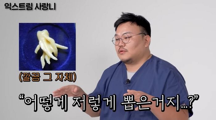 “어떻게 뺐나요?...” 현직 치과의사 마저도 당황한 ‘레전드 사랑니’ (영상)