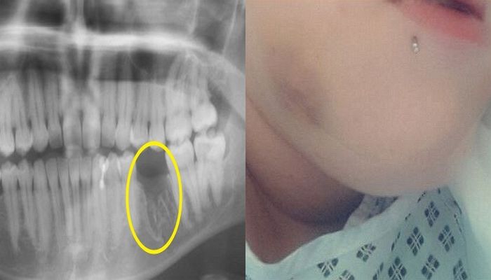 치과의사가 썩은 치아 뽑다 턱뼈 박살 냈다며 환자가 공개한 엑스레이 사진
