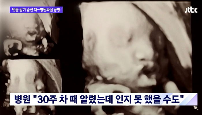 “지난주까지 건강했던 뱃속 아이가 ‘탯줄’이 감겨 숨진 채 태어났습니다”