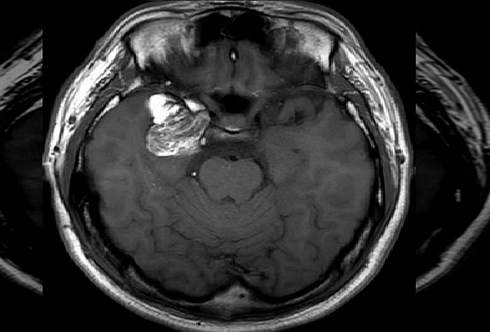 뇌종양인데 4급 공익 판정받은 남성에 여초 커뮤니티 회원들이 보인 반응