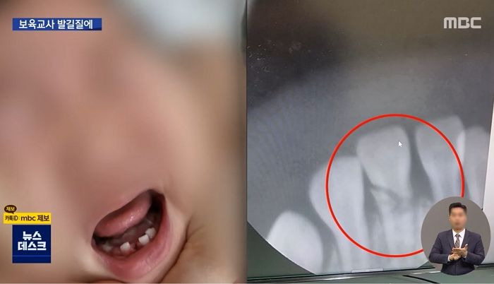 “13개월 아기 발길질로 치아 부러뜨려”...양산 어린이집 원장·교사 ‘350차례’ 상습 아동학대