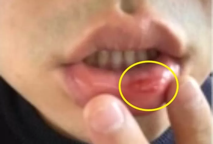 “식당 사장한테 포크 달라고 했다가 입술 터지게 맞았습니다”