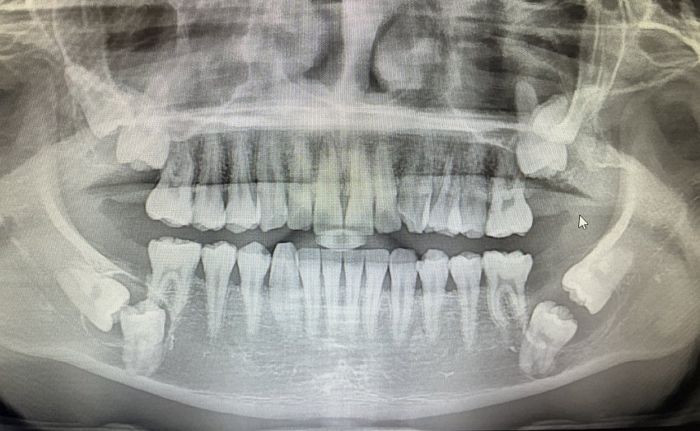 X-ray로 촬영해 본 수술비만 ‘300만원’ 나온 매복 사랑니 상태