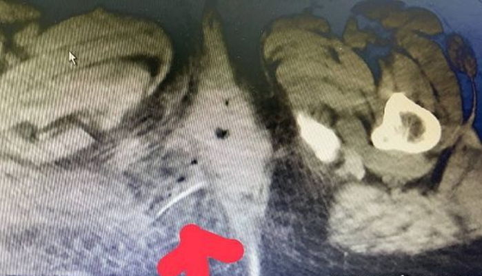생선 먹다가 삼킨 4cm짜리 가시가 ‘직장’ 뚫어 평생 병원 신세 지게 된 여성