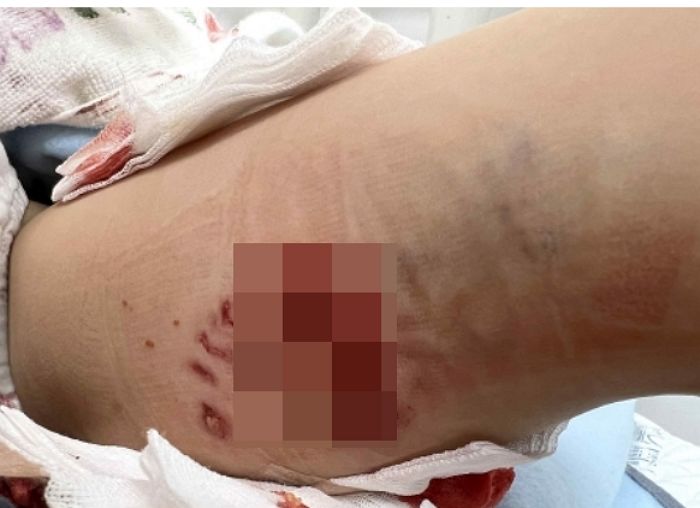 늑대견 5마리에 물려 7살 딸 12군데 찢어졌는데 ‘우리 개 착하다’는 견주