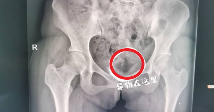 남친과 성관계 한 뒤 고통 호소하며 온 여대생 몸에서 산부인과 의사가 찾아낸 물건